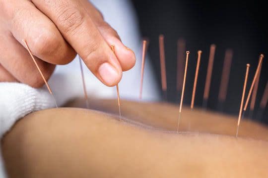 Acupuncture therapy on the back