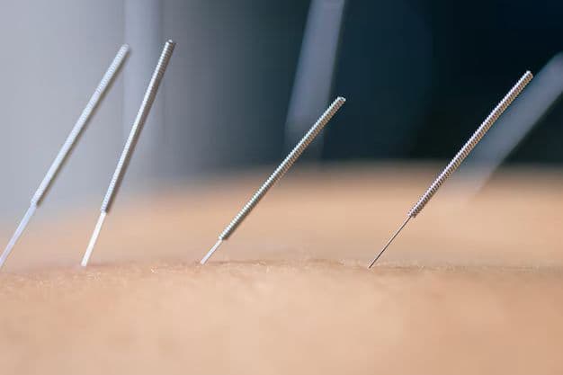 Acupuncture needles close-up