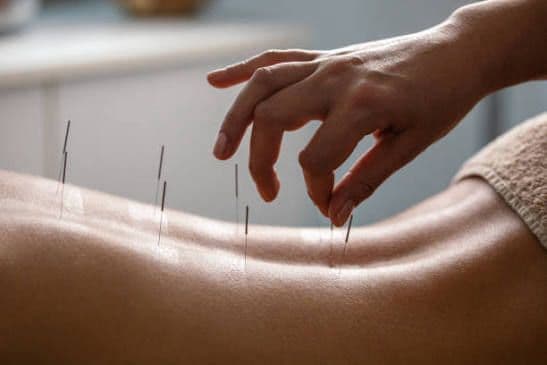 Dry needling on the lower back