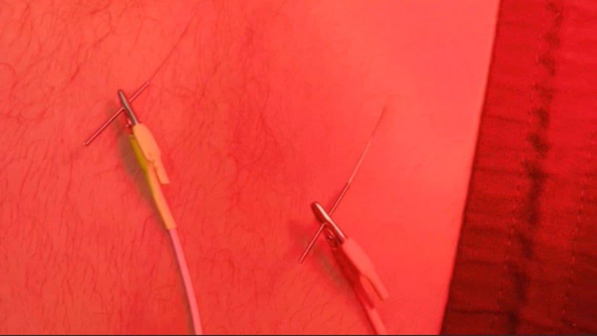 Electro-acupuncture electrodes close-up