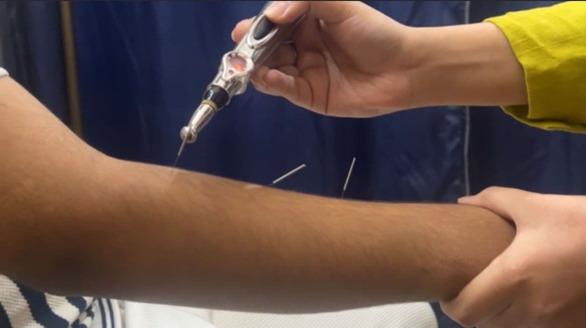 Electro-acupuncture treatment on the forearm